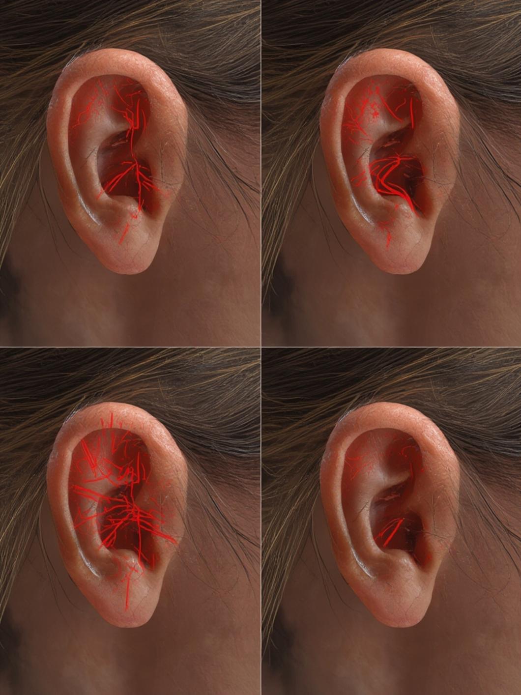 pulsatile tinnitus